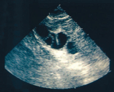 Eibläschenpunktion im Rahmen der In-vitro-Fertilisation (IVF)