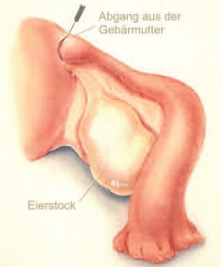 Eileiterverschluss am Abgang aus der Gebärmutter